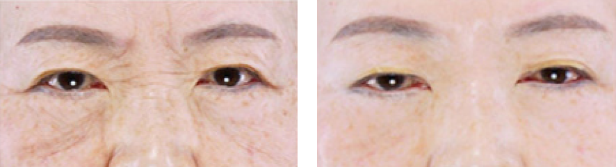 Resultados do tratamento na face